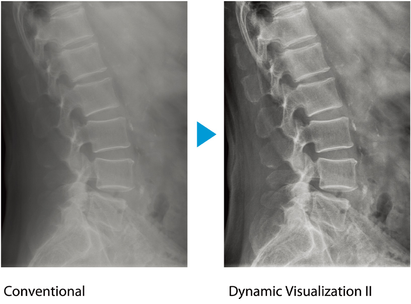 [photo] 2 X-ray images - one with conventional processing and the other with Dynamic Visualization II​​