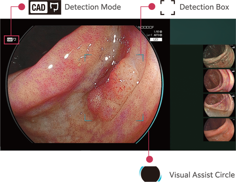 CAD EYE detection working with LCI mode in the colon. Displayed icons explained.