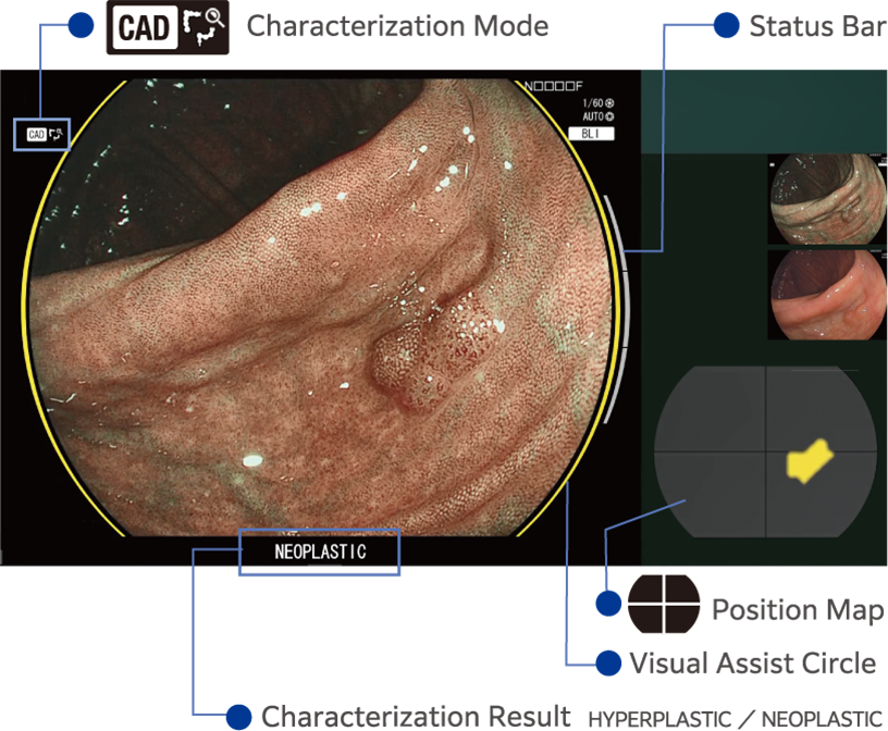 CAD EYE characterization working with BLI mode in the colon. Displayed icons explained.