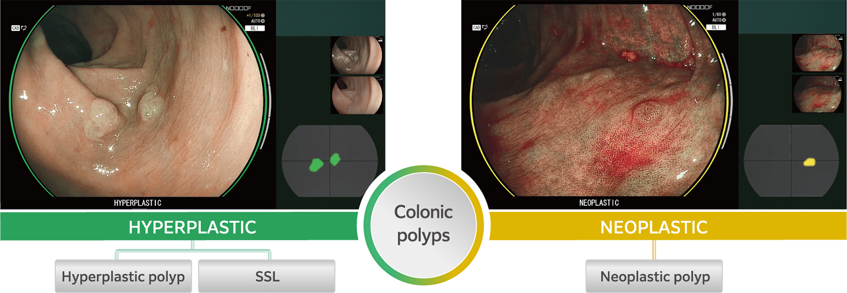 CAD EYE characterization working with BLI mode in the colon. HYPERPLASTIC lesions are colored green.CAD EYE characterization working with BLI mode in the colon. NEOPLASTIC lesions are colored yellow.