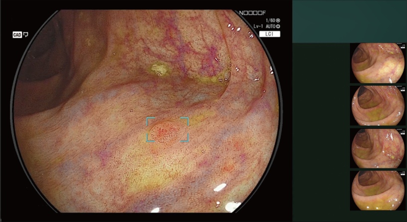 CAD EYE detection working with LCI mode in the colon.