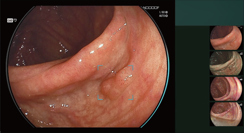CAD EYE detection working with White Light mode in the colon.