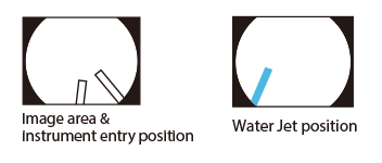 Diagram showing how therapeutic devices appear on endoscopic image./Diagram showing how water jet appears on endoscopic image.