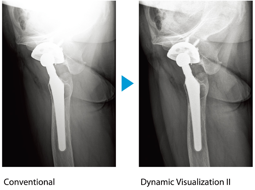 [photo] 2 X-ray images - one with conventional processing and the other with Dynamic Visualization II​​