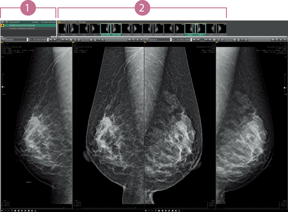 [image] Mammography (2D/Tomosynthesis/Comparisons with prior images)