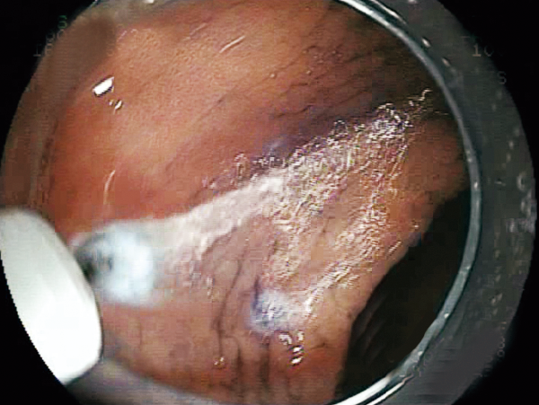 Clinical Image ：Water jet