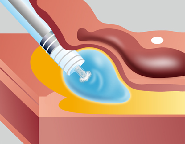 Submucosal Injection Image Diagram​