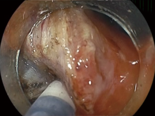 Clinical Image ：Submucosal dissection