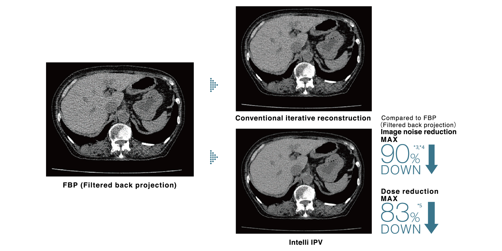 Filtered back projection/Conventional iterative reconstruction/Intelli IPV