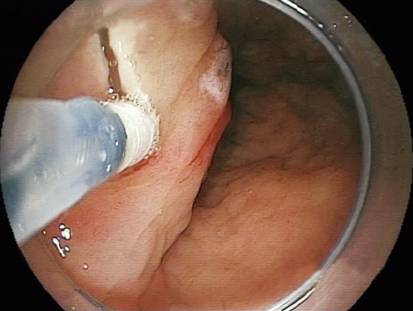 Clinical Image ：Mucosal Injection