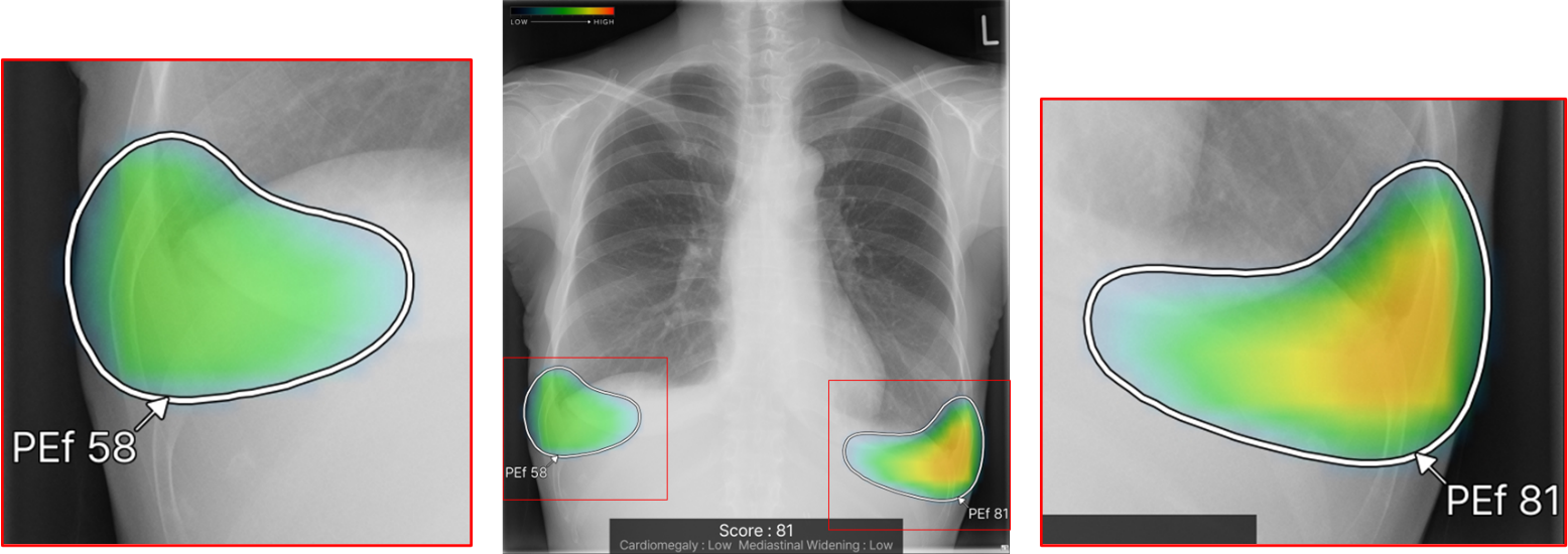 胸部X線画像病変検出ソフトウェア「CXR-AID Ver3.0」提供開始 | 富士