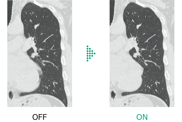 Here are comparative images of coronal cross sections in the chest region, showing differences without and with Body StillShot, which suppresses motion blur. Body StillShot can be combined with Intelli IPV, and it is a dedicated option for the Operator Console CT-OC-23D. Intelli IPV was developed using AI-based machine learning, but its performance does not automatically improve after implementation. IPV stands for Iterative Progressive reconstruction with Visual modeling.