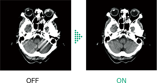 Here are comparative images of the axial cross sections in head scans.They show the differences between cases without and with the Body Motion Correction, demonstrating that artifacts are suppressed.