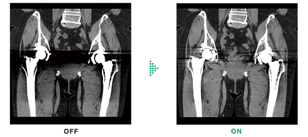 Here are comparative images of the thigh region. They show the differences between cases without and with the HiMAR Plus function.
