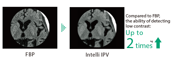 Here are comparative images of the head region. One is the filtered back-projection (FBP) image, and the other is an Intelli IPV image. Low contrast detectability, measured at 0.625 mm slice thickness and at the Intelli IPV intensity level Strong5 on the MITA CT IQ phantom by Phantom Laboratory using the model observer method, is improved by up to two times compared to FBP. Effects may vary based on clinical task and other factors.