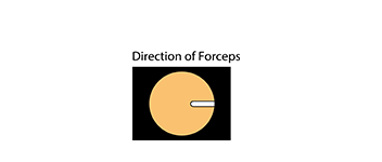 Image area and dirrection of forceps