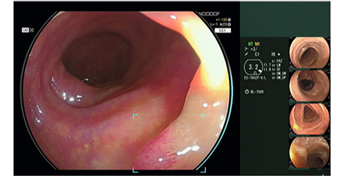 CAD EYE Detection
