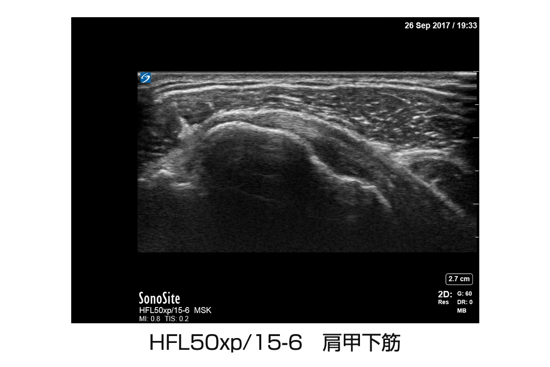 HFL50xp/15-6 肩甲下筋