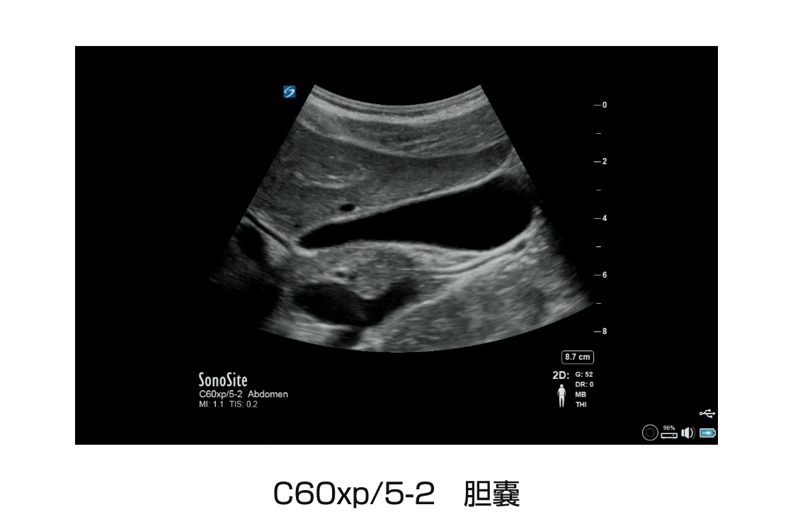 C60xp/5-2 胆嚢