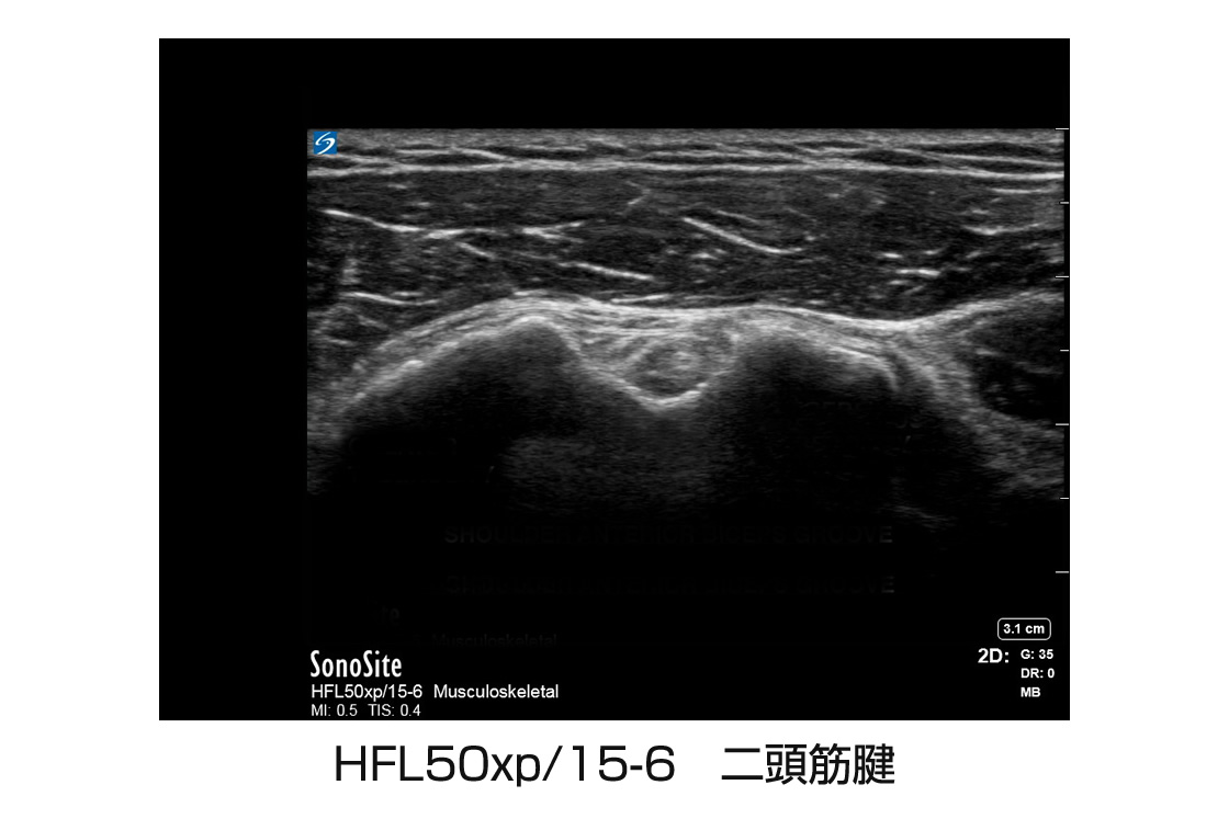 HFL50xp/15-6 二頭筋腱