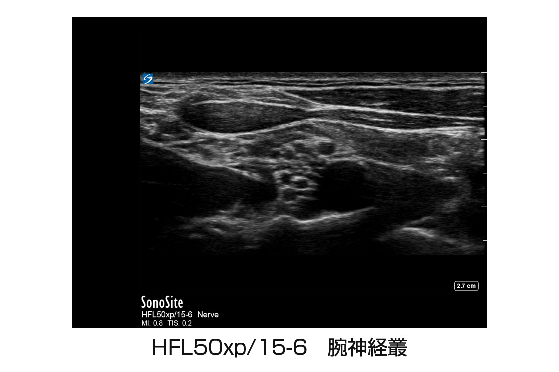 HFL50xp/15-6 腕神経叢