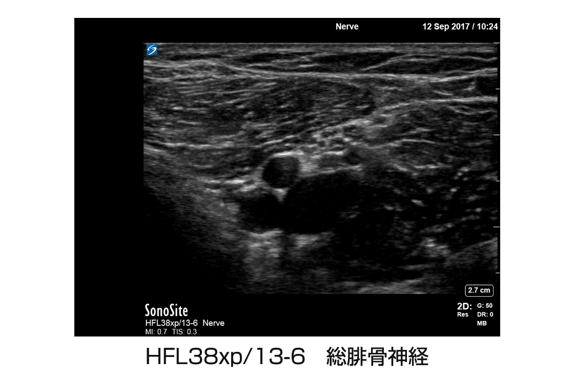HFL38xp/13-6 総腓骨神経