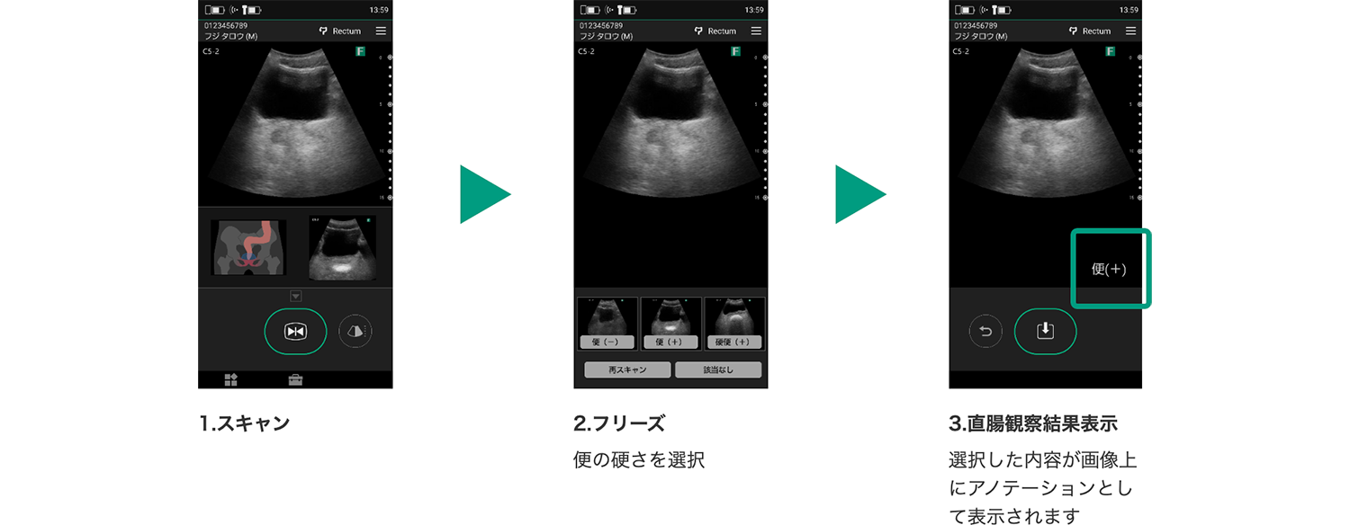 1.スキャン 2.フリーズ 便の硬さを選択 3.直腸観察結果表示 選択した内容が画像上にアノテーションとして表示されます