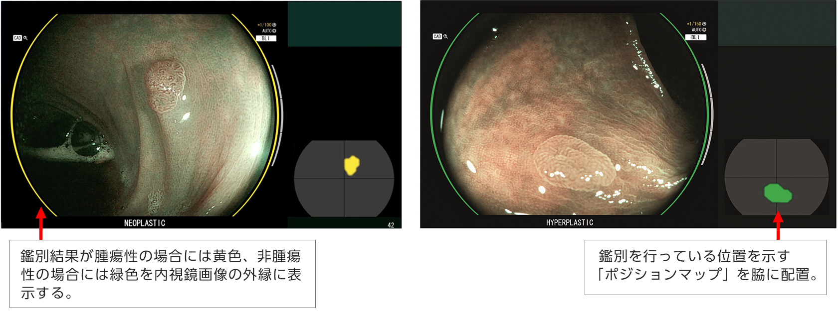 内視鏡診断支援機能 Cad Eye キャド アイ 新発売 富士フイルム 日本