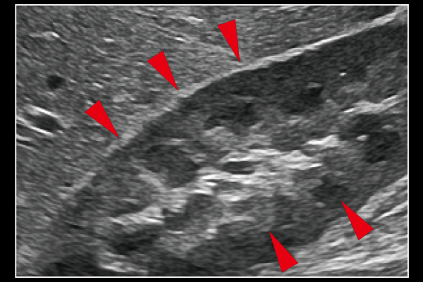 Carving Imaging ONの画像です。組織構造の視認性を追及した「見やすい」画像を実現。被検者依存の少ない安定した描出を実現します