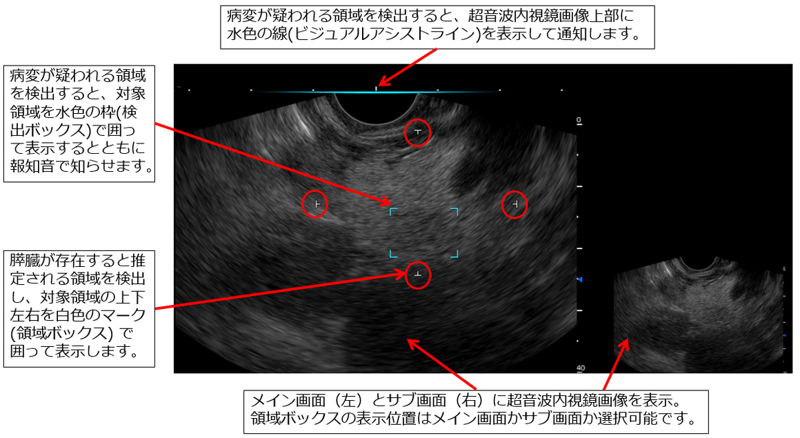 超音波内視鏡検査において、富士フイルムが開発したソフトウェアが、膵臓が存在すると推定される領域および膵充実性病変が疑われる領域を検出する様子