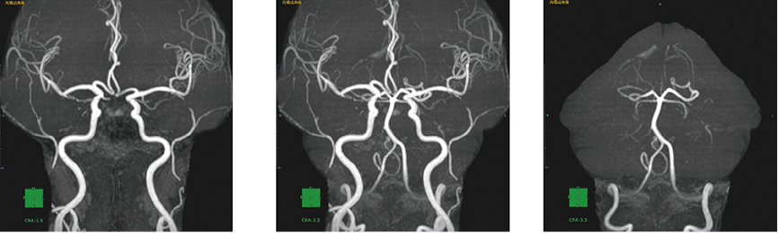 脳抽出のイメージ図