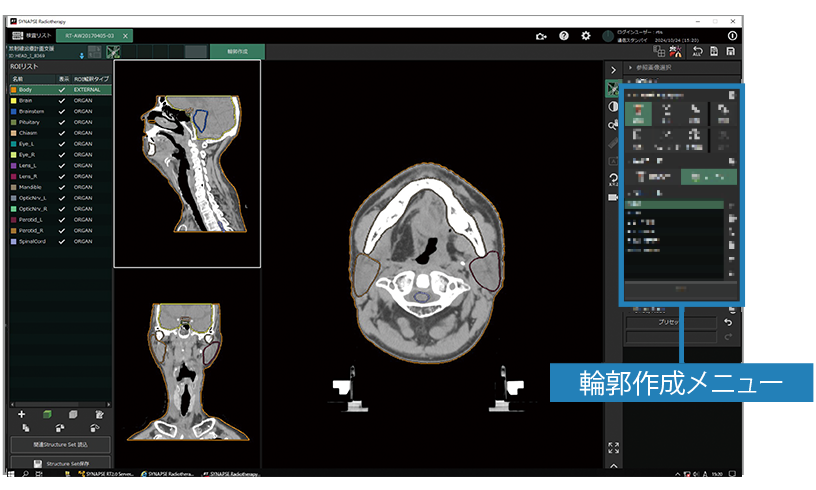 放射線治療計画支援ソフトウェア SYNAPSE Radiotherapy | 富士