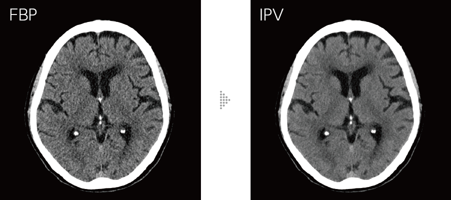 FBPとIPVの比較画像