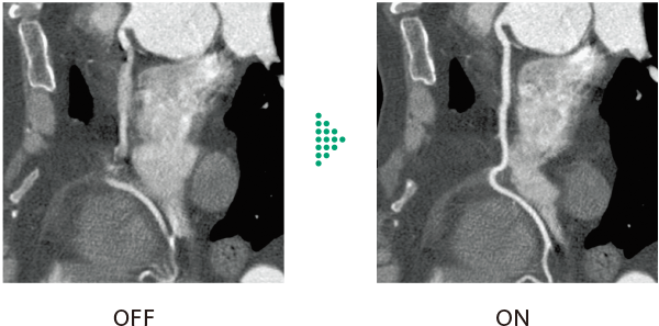 Cardio StillShot機能 ONとOFFの臨床画像