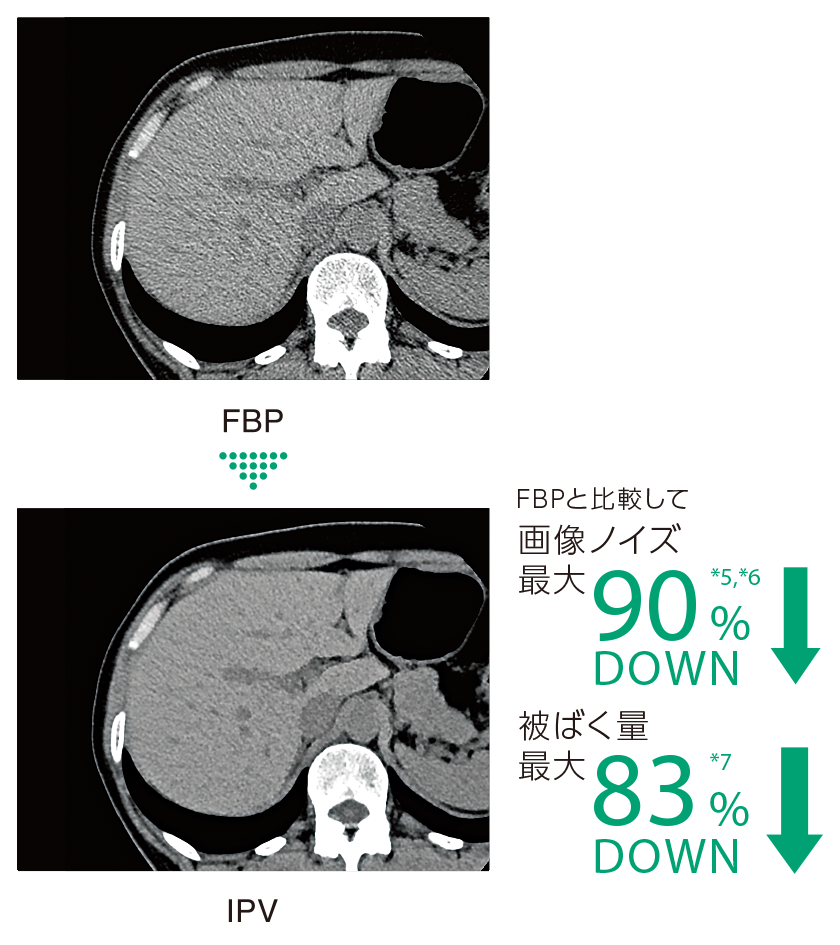 IPV機能による、画像ノイズと被ばく量の低減を示した臨床画像