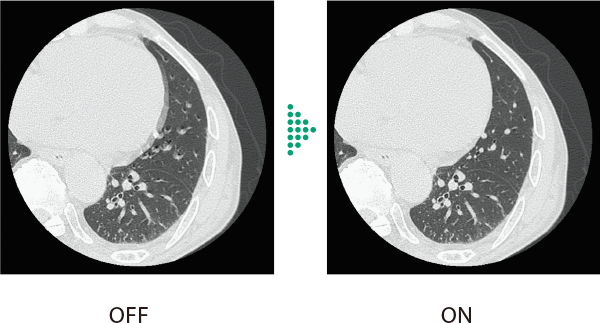 Body StillShot機能 ONとOFFの臨床画像