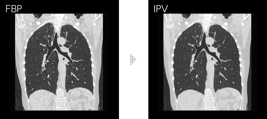 FBPとIPVの比較画像 