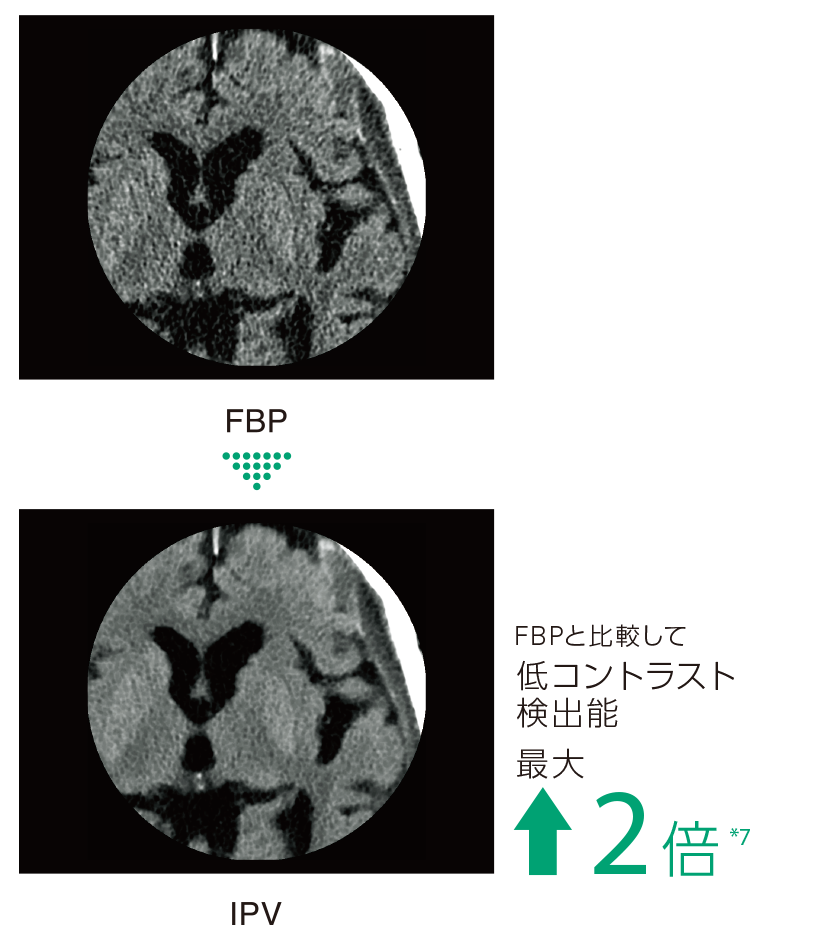 IPVによる低コントラスト分解能向上を示した臨床画像