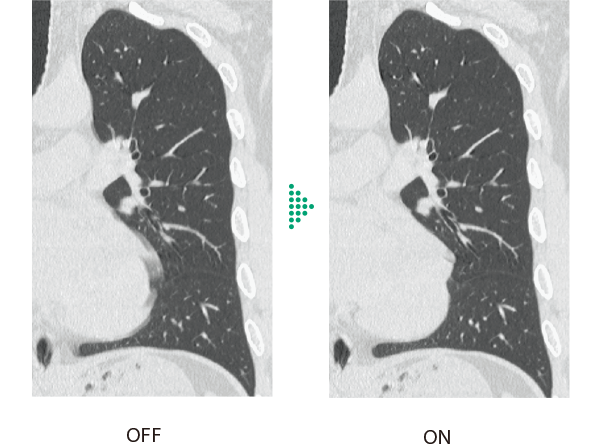 Body StillShot機能 ONとOFFの臨床画像