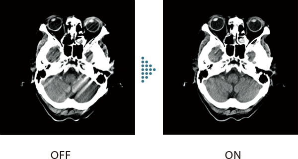 体動補正機能 ONとOFFの臨床データ