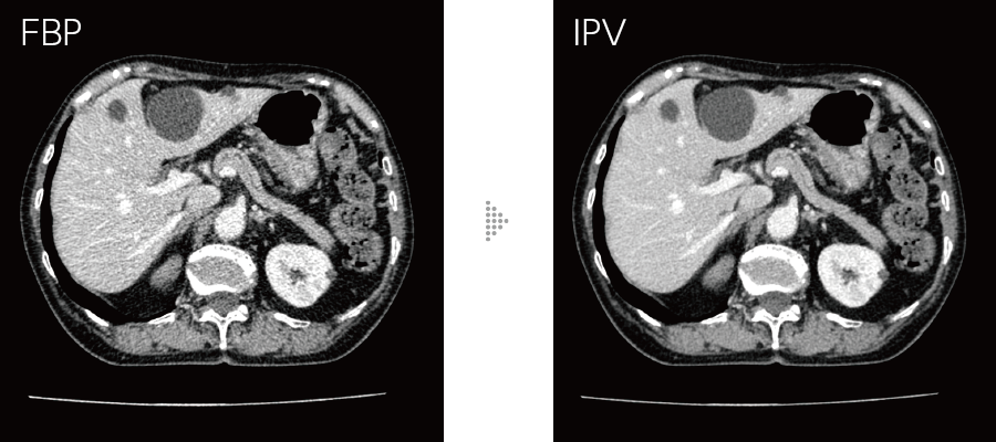 FBPとIPVの比較画像