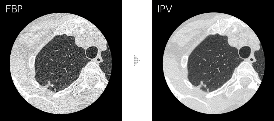 FBPとIPVの比較画像 