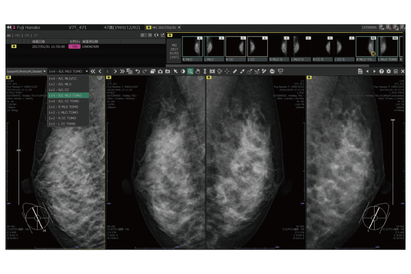 マンモグラフィビューワのイメージ画像