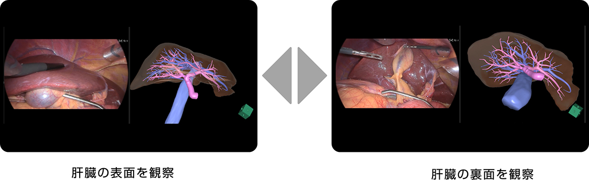 手術中の内視鏡映像から肝臓の向きを解析し、事前に作成した肝臓の3D画像を内視鏡映像にあわせて表面や裏面を観察している様子