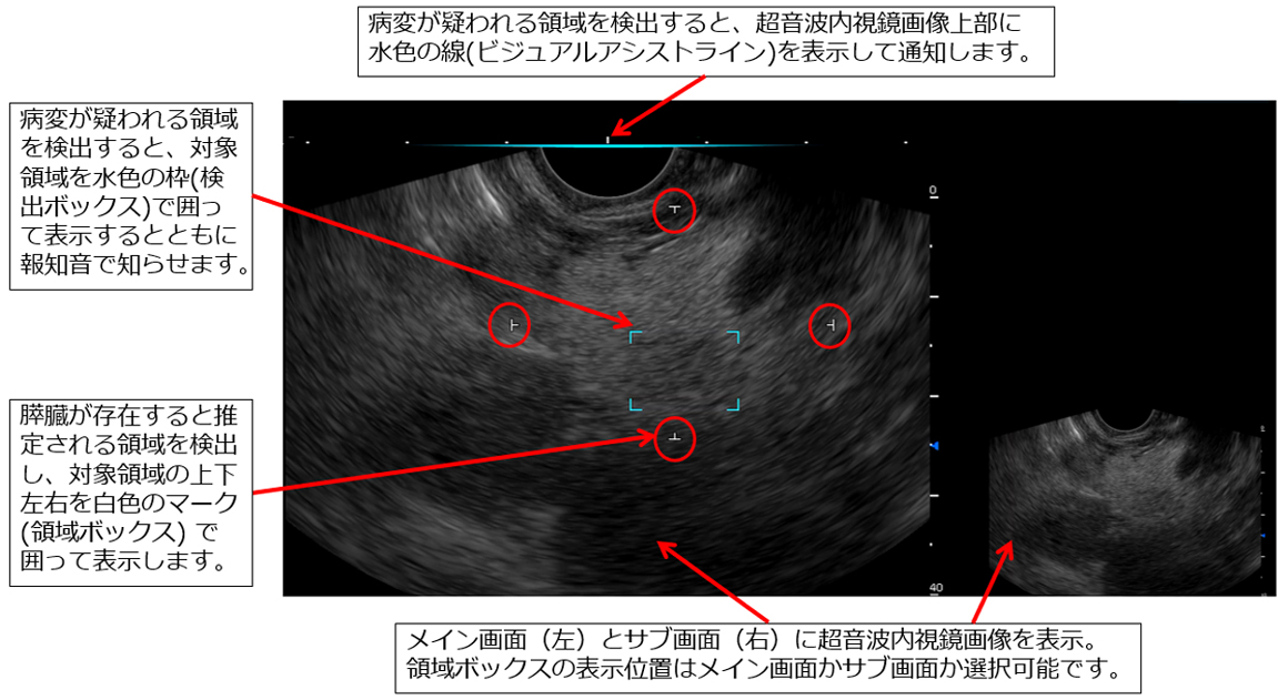 超音波内視鏡検査において、富士フイルムが開発したソフトウェアが、膵臓が存在すると推定される領域および膵充実性病変が疑われる領域を検出する様子