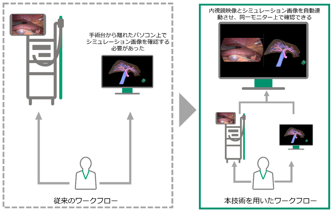手術中に、手術台から離れたパソコン上で事前に作成したシミュレーション画像をみる従来のワークフローと、内視鏡映像とシミュレーション画像を自動連動させて同一モニター上で確認する本技術を用いたワークフローを比較した様子