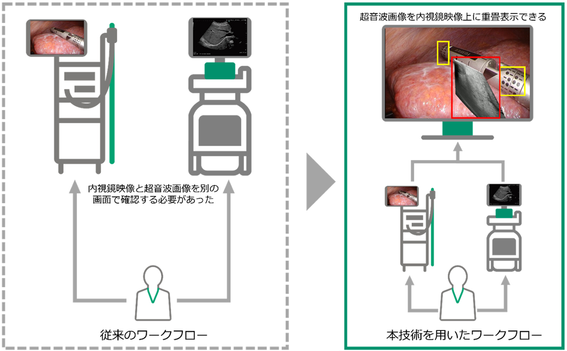 術中超音波検査中に、内視鏡映像と超音波画像を別の画面で確認する従来のワークフローと、超音波画像を内視鏡映像上に重畳表示する本技術を用いたワークフローを比較した様子
