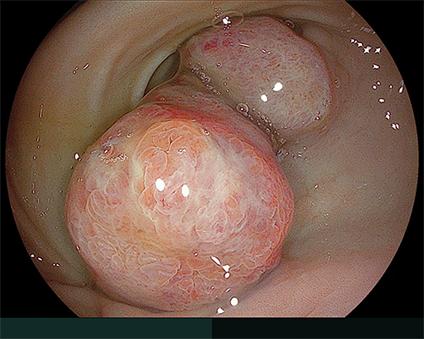 内視鏡症例画像