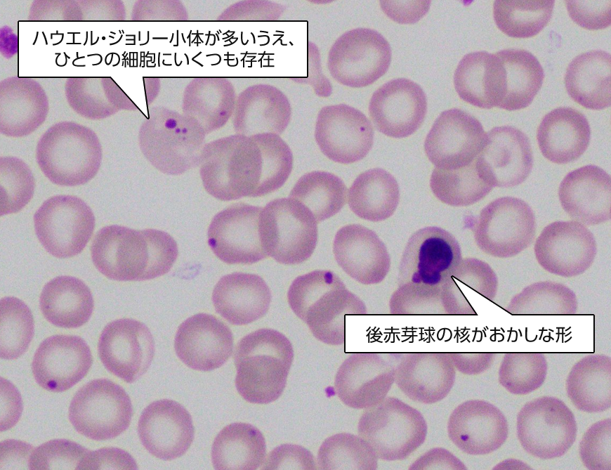 ハウエル・ジョリー小体が多いうえ、ひとつの細胞にいくつも存在／後赤芽球の核がおかしな形
