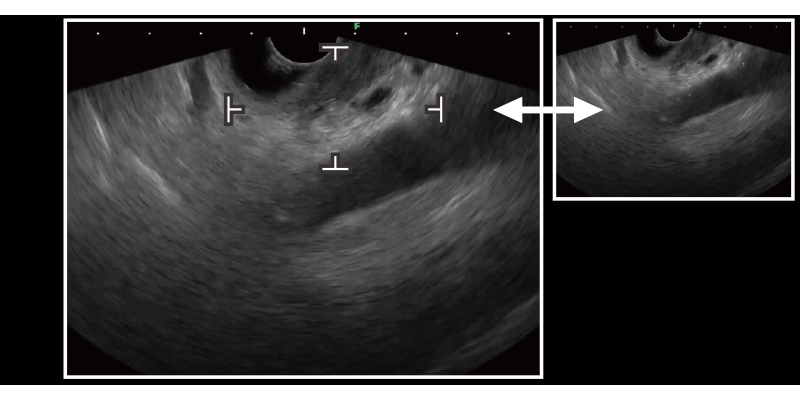 膵臓が存在すると推定される領域を検出した超音波内視鏡画像​​